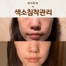 미미반점&산동성 | BBL쥴레이저, 레블라이트 색소침착관리 기미레이저후기 통증 효과