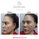 뷰리안의원 | [뷰리안의원/실리프팅]실종류, 제대로 알고 선택하자! 내 피부에 꼭 맞는 실은?