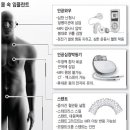 심혈관에 스텐트(스테인리스 스틸 재질) 넣었다면, MRI 검사 주의하세요 이미지