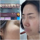 연세의원 | 전주 흑자 리팟레이저 연세비비의원 리얼후기 평편사마귀 기미 상담 시술 사후관리