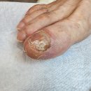 포쉬네일 풀리메디 안산점 | 안산발톱무좀 아빠 발톱 고민 해결해드린 포쉬네일 동성제약 풀리메디 안산점