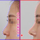 코원성형외과의원 | 화살코수술 + 이마지방이식 / 컴플렉스완벽개선★/ 코지방이식후기