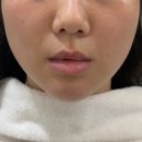 인앤아웃커피 | 강동구피부관리 러블랑 인앤아웃리프팅 받고 턱선 살아난 암사동피부관리 후기