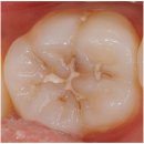 양구치과의원 | 양구치과, 충치 레진 치료는 '이것'때문에 실패한다? [의사 조언]