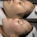 프라블 | 선릉 피부관리ㅣ강남 슈퍼젝션으로 탄력있는 피부관리, 프라블
