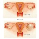난소낭종 - 증상 & 분류 & 주기 이미지