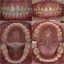 서울고운미소치과교정과치과의원 | [연세고운미소치과강동점]인비절라인을 통한 돌출입 해결 증례