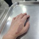 서울화외과의원 | 의정부 민락 화상전문병원 서울화외과 (표재성2도화상,혐오주의)