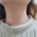 우아인성형외과의원 | 신논현역 우아인 성형외과 가로목주름 필러 후기