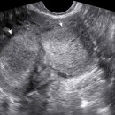 초음파 검사와 MRI 검사에서 암의 크기가 다를 수 있나요? 이미지