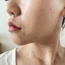 메디큐브의원 | 강남여드름 메디큐브피부과에서 여드름자국 레이저 시너지레이저 솔직후기!