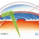 녹내장 초기 및 원인 검사 자가진단 : 20대 30대 녹내장 이미지