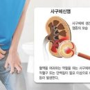 급성 사구체신염 증상 부종과 혈뇨가 나타나는 이유 이미지