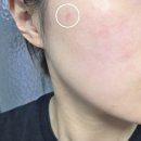 치유약국 | 픽시카겔 약국 가격 성분 사용법 여드름 진정 후기