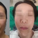 미르피부과의원 | 부산 서면 덴서티 알파, 피부가 얇아 고민이라면? (반쪽 시술 직후 변화 공개)