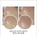 여드름살롱 네이버블로그