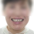 페이스치과기공소 | 앞니 블랙트라이앵글, 앞니 벌어짐 치료 - 무삭제 라미네이트 미니필름