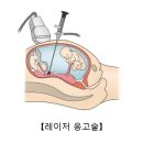 쌍태아 수혈 증후군[Twin to twin Transfusion Syndrome여성질환] 이미지