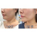 리얼전 | 부산 서면 온다리프팅 이중턱 심부볼 리얼후기 - 결혼식전 예신관리 추천