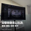 홍대미래치과의원 | 홍대 사랑니 발치 후기 사랑이아프니치과 | 위에 2개 뽑고 왔음