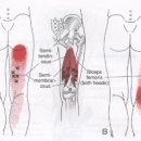 * 근막통 증후군 (햄스트링근) 이미지