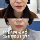 60 | 강남 신논현 실리프팅 후기, 60대 엄마 심부볼 민트실 리얼후기