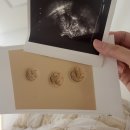 에프45 가산 | (난자채취 7차-5) 신선이식 3일배양, 3개이식 - 시험관 총비용