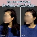 채움 | 엄마 헤어라인 인생역전… 강남 두피채움 리얼후기