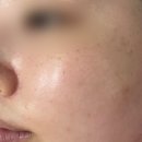 아쿠아필 수소토닝관리 후기 | 이끌림 밸런스케어