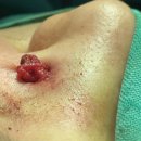 창원이루다성형외과의원 | 📋[창원진해피지낭종제거] 재발률이 낮은 피지낭종 제거 방법은?전문가 의견 정리