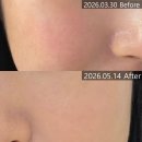 빈스뷰티 재방문 후기 신기하게 얼굴이 작아지는 작은얼굴관리!