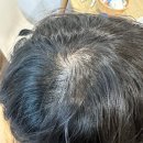 오리엔탈파마 | 여자 가르마 탈모 더마프샴푸로 관리중