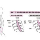 노화하면 허리통이나 무릎통, 관절이 변형하기 쉬운가？ 변형성 무릎관절증이 진행하면 O다리가？ 이미지