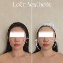 마산회원구 ⓑ-17 | 마산 피부관리 양덕동 로에르에스테틱 V이중컷팅조각술 후기