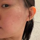 지성병원 | 인천 편평사마귀 성지 ‘포메디 한의원’ 에서 편사 150개+@ 제거한 내돈내산 매우솔직 후기