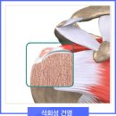 어깨석회성건염 은 이미지