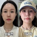 란 스킨 | 선릉피부과 30기 옥순 고우리 스킨부스터 효과 후기
