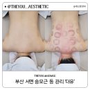 (유) 한결 | 부산 서면 승모근관리 등관리 잘하는 더유에스테틱 후기