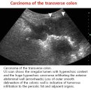 Carcinoma of the transverse colon 이미지