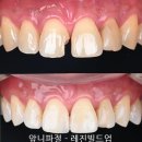 부평아름다운치과의원 | 앞니 레진 파절을 레진빌드업으로 크라운 수복 없이 치료 - 인천 부평 동암역치과
