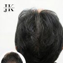 제이케이두피부띠크(JK두피부띠크) | 30대 남자 정수리 탈모, 건강한 두피커버 JK두피부띠크