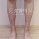 경화반점 이미지