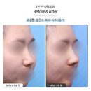 마인드성형외과의원 | 코성형 전후, 낮고 퍼진코에서 자연스럽게 높이감 있는 직반라인으로! | 마인드성형외과