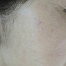 젠 | 창원 코코리젠 관리 후기｜기미·잡티·쥐젓·검버섯까지 케어 “네일리 창원본점”