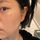 하남미사보톡스,검색했다면 꼭 확인할 스킨보톡스 반응 차이