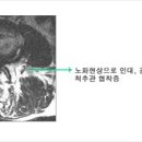 요추관 협착증(대한척추신경외과학회) 이미지