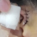 시원이비인후과의원 | 전주 이루공 수술 후기｜김양박이비인후과 선천성 이루공 수술 경험담