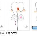 [중년을 노리는 질환] 잇몸질환 이미지