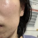 누림축산 | 마포구청역 피부관리 이모아에스테틱 | 좁쌀여드름 진정관리 후기 웨딩케어