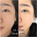 강동-천호-2438 | [강동역 피부관리] 미작뷰티 강동점 | 천호역피부관리 기미잡티제거 클리어스팟 미백관리 1회차 후기